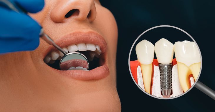 Glow Magic Energy Through Premium Dental Implants in Dubai