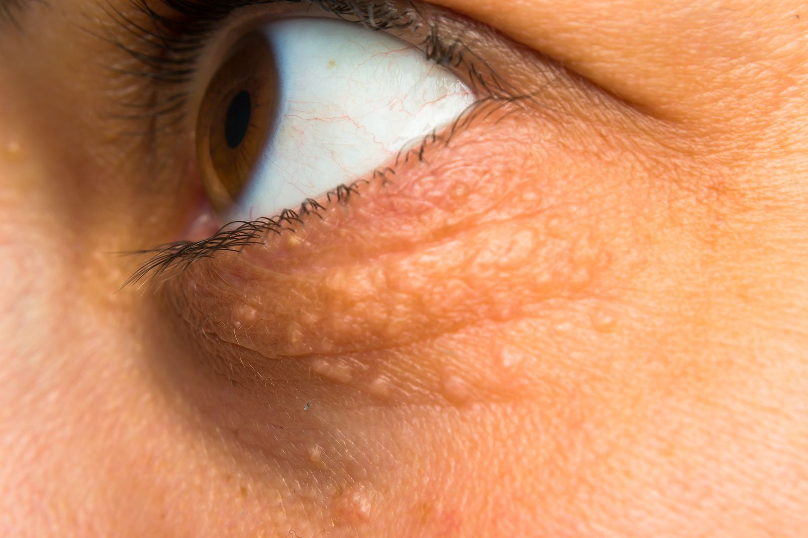 Your Guide to Choosing Eyelid Xanthelasma Removal Services