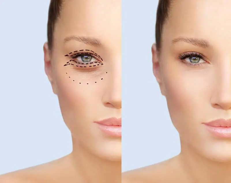 Why Blepharoplasty Is a Popular Choice for Elegant Eye Enhancement