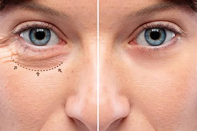 Eye Bag Removal for Men Seeking a Fresher and Refined Look